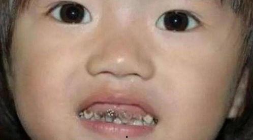 吃瓜把牙齿咬坏了,牙齿“咬”出健康危机  第1张